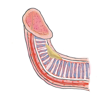 Am penis knubbel Peniskrebs (Peniskarzinom)